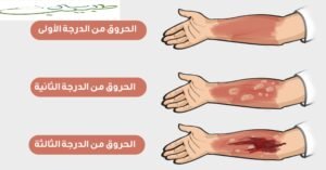 درجات الحروق
