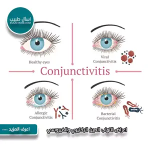 اعراض التهاب العين البكتيري والفيروسي