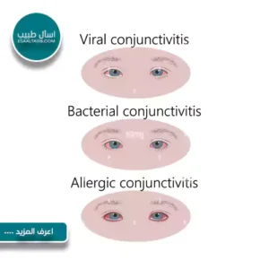 التهاب العيون