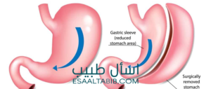 شكل يوضح تكميم المعدة