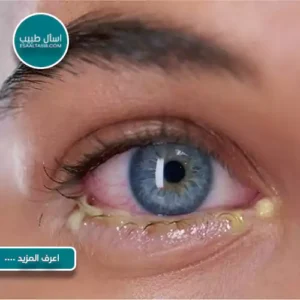 متى يكون التهاب العين خطير