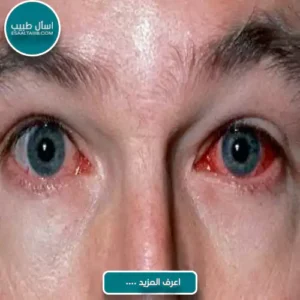 تشخيص التهاب العين الفيروسي