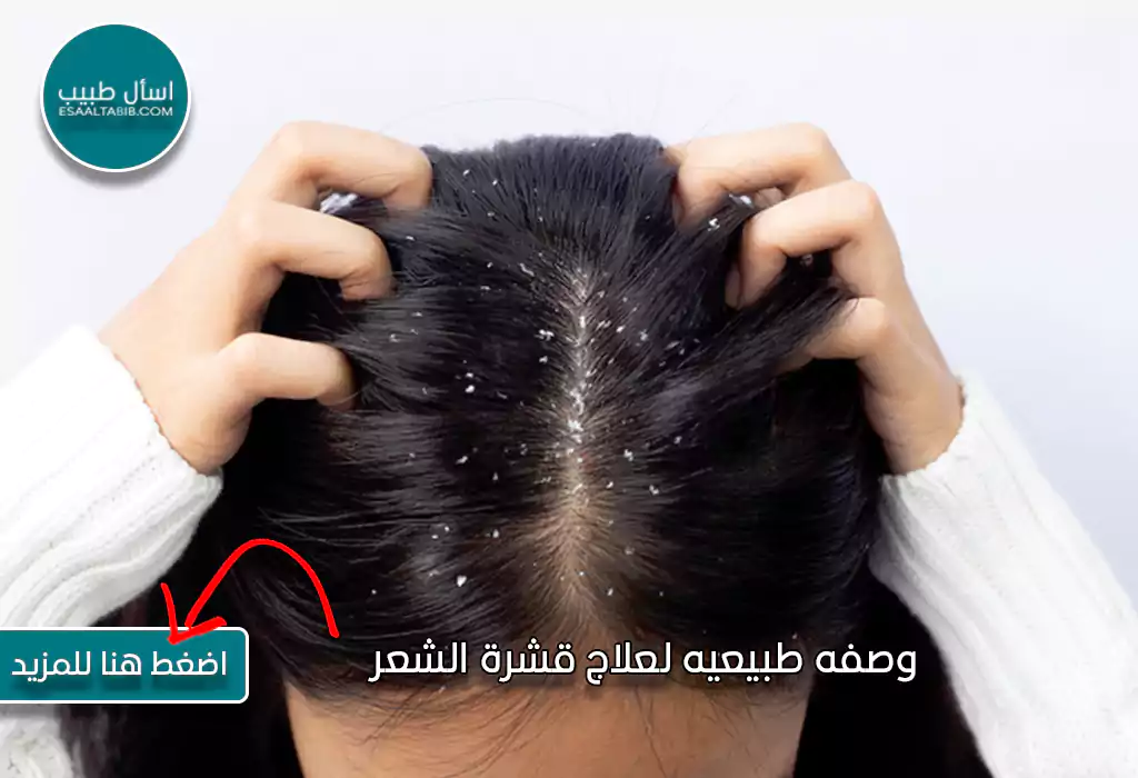 وصفه طبيعيه لعلاج قشرة الشعر