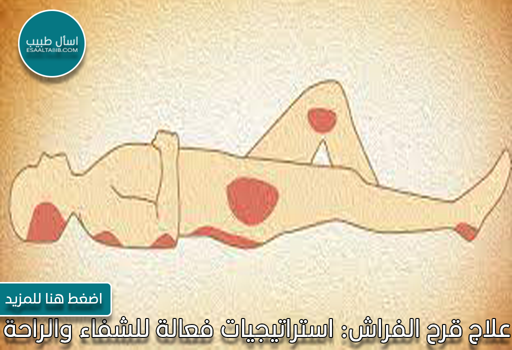 علاج قرح الفراش