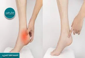 اعراض الشوكه العظمية
