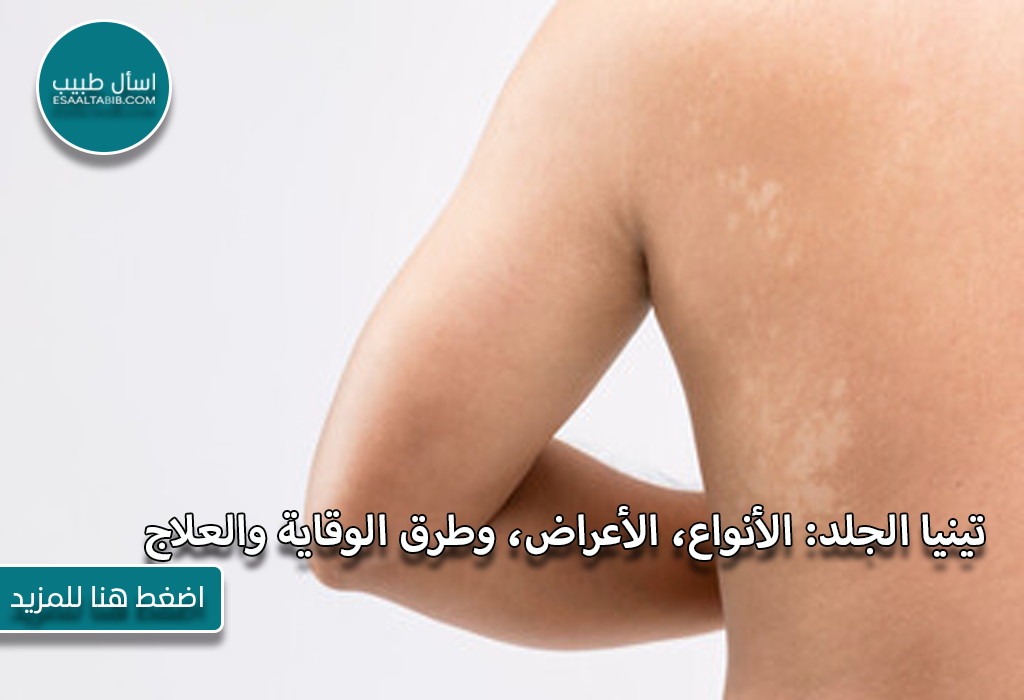 تينيا الجلد الأنواع الأعراض