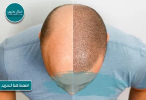 زراعة الشعر