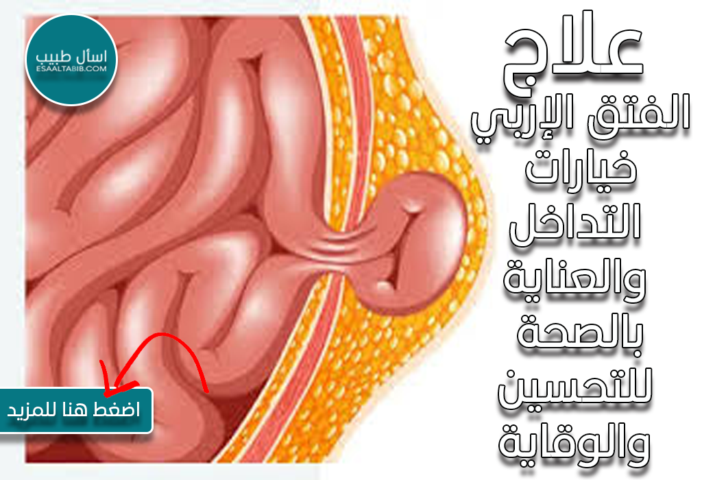 علاج الفتق الإربي