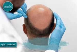 فقدان الشعر