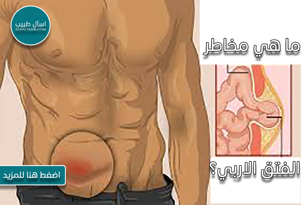 ما هي مخاطر الفتق الاربي