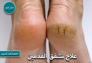 علاج تشقق القدمين