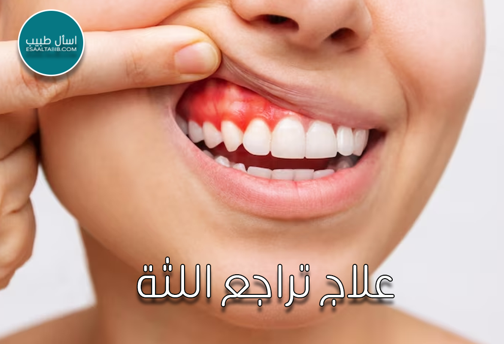 علاج تراجع اللثة