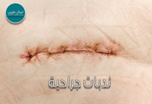 ندبات جراحية