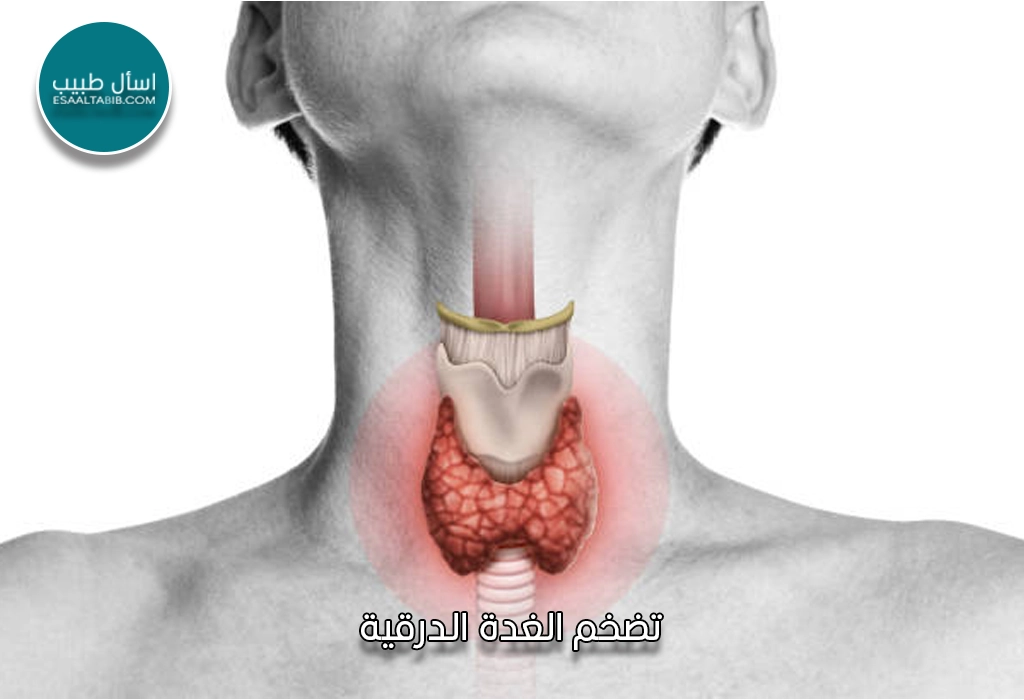 تضخم الغدة الدرقية