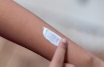صورة تُظهر اضطراب البهاق مع بقع بيضاء غير منتظمة على الجلد
