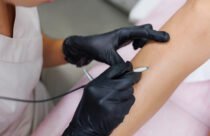 إزالة الشعر بالليزر عملية تستهدف بصيلات الشعر باستخدام الضوء